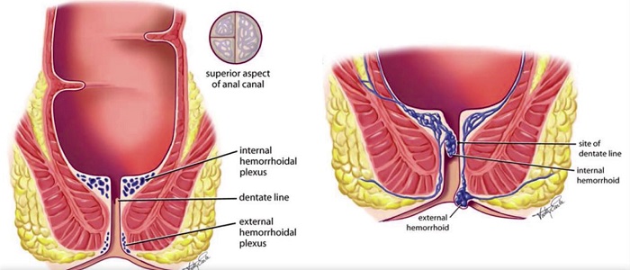 Hemoroid Nedir?