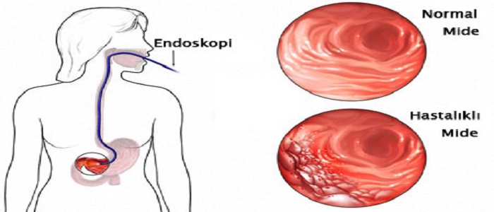 Mide Kanseri Nedir?