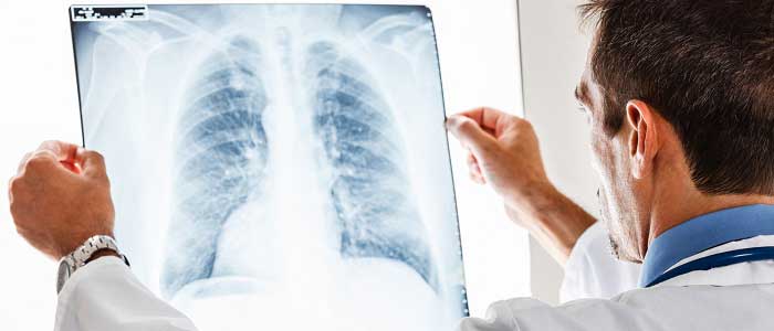 Akciğer Kanserinin Tedavisi