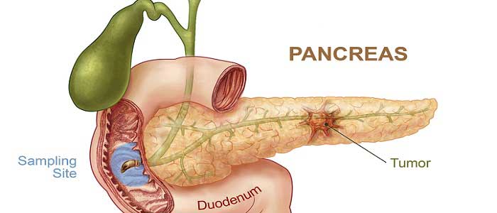 Pankreas Kanseri Nedir?