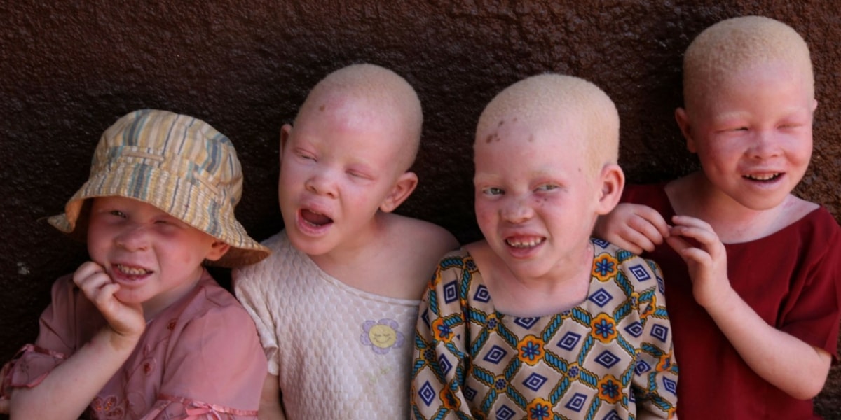 Albinizm (Albino) Çeşitleri Nelerdir?