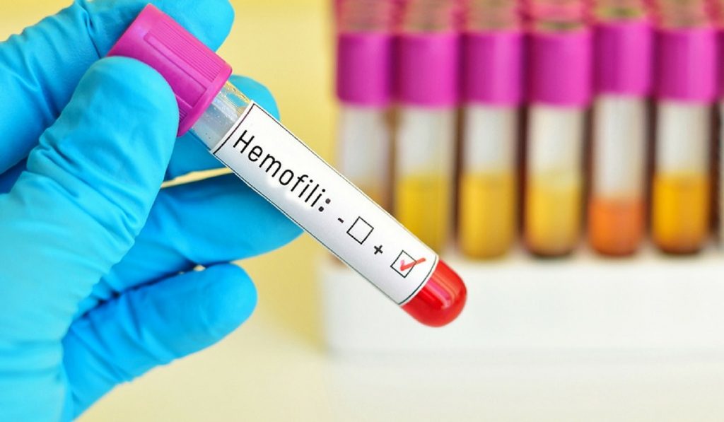 Hemofili Nedir? Nedenleri, Belirtileri, Korunma Yolları ve Tedavisi