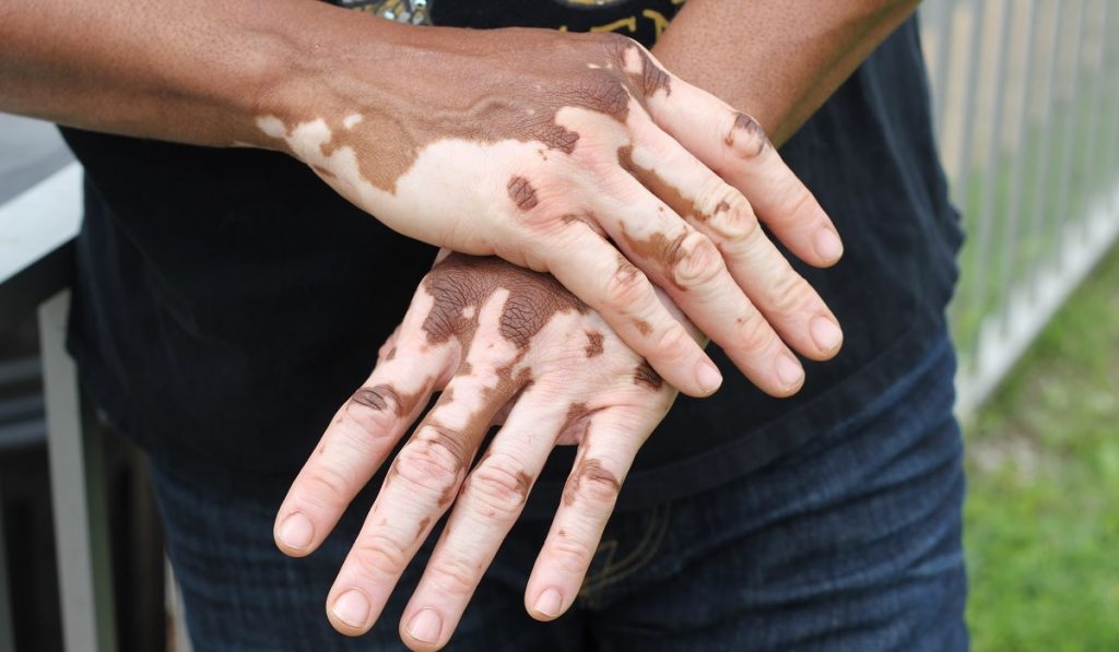 Vitiligo (Ala Hastalığı) Nedir? Nedenleri, Belirtileri, Korunma Yolları ve Tedavisi